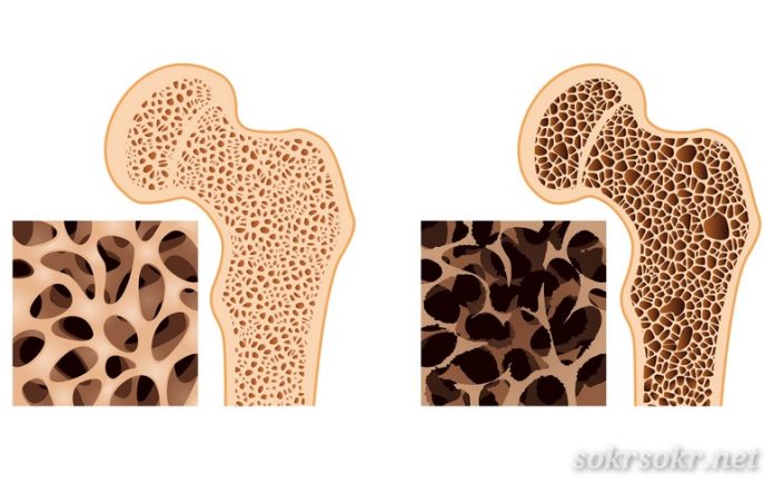 Osteoporosis